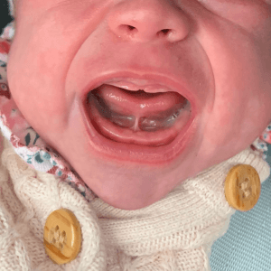Baby crying, showing tongue lift and visible frenulum