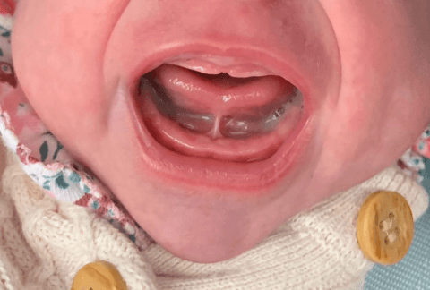 Baby crying, showing tongue lift and visible frenulum