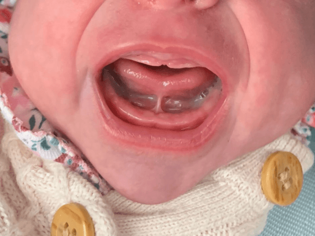 Baby crying, showing tongue lift and visible frenulum